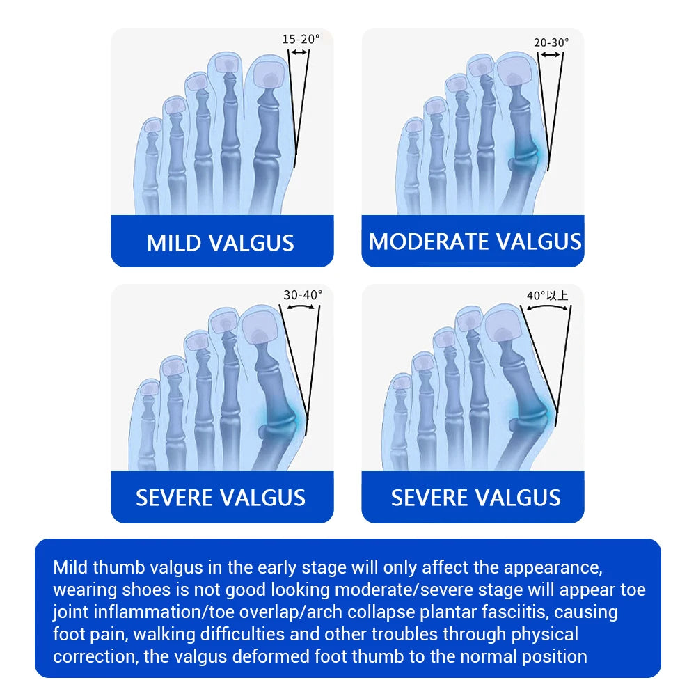 CowLost | bunion-corrector-unisex-valgus-toe-correction-pain-relief-foot-treatment |10
